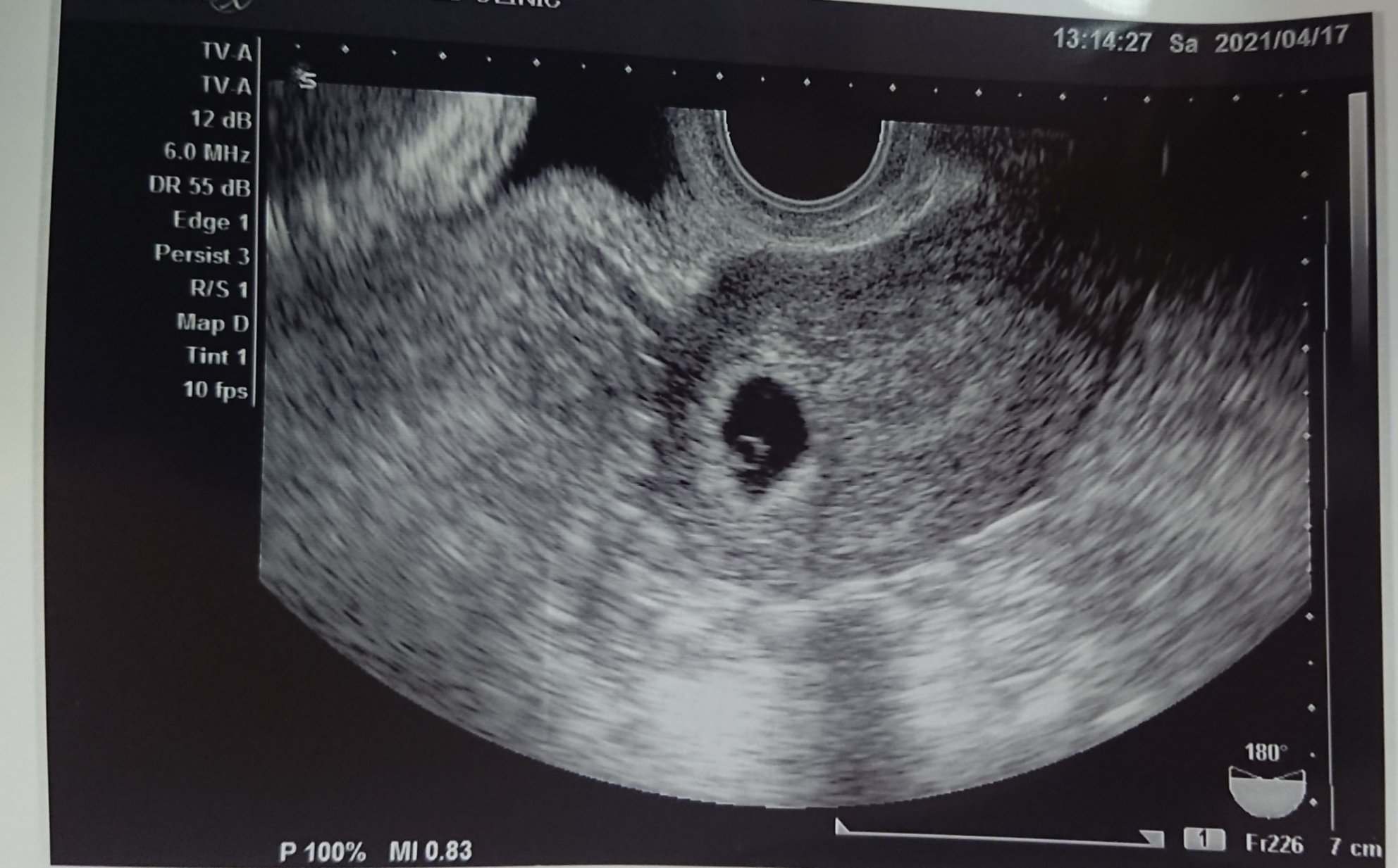 しいのさん 34w On Twitter エコー中バクバク ん カルテ見せて と 先生の声がして 怖くて画面見れない うん 6週で胎嚢と卵黄嚢見えたね 順調 チラッ いた 無事 卵黄嚢まで確認出来ました 26日 心拍確認出来たら不妊治療