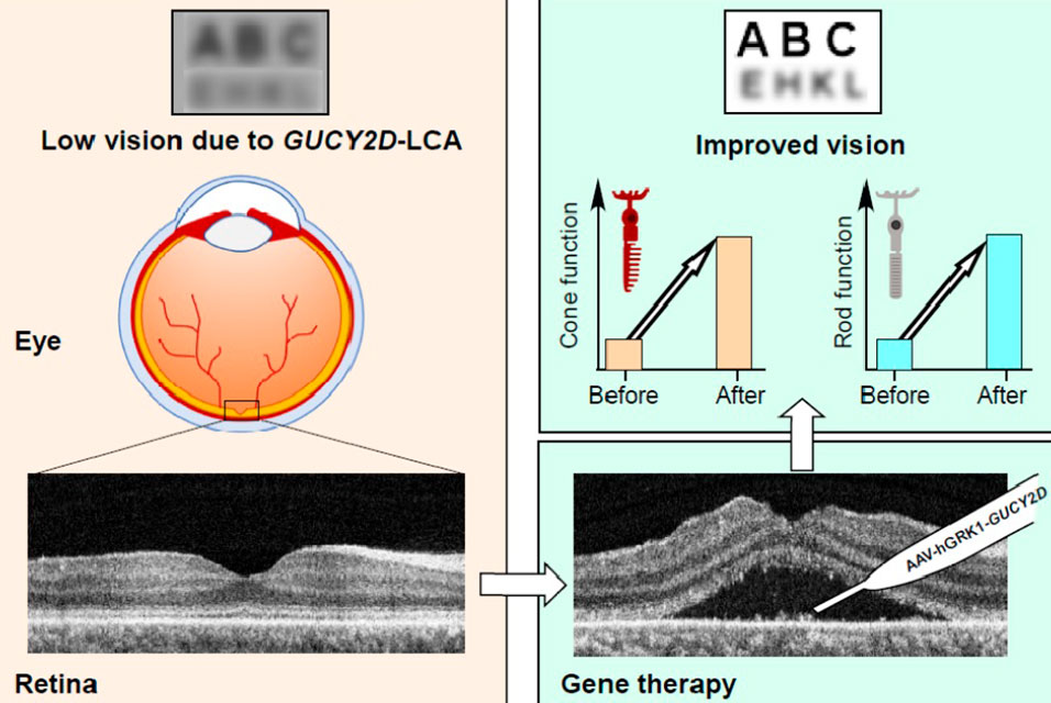 Gene therapy shows promise in initial trial for patients with childhood blindness #genetherapy #trial #childhoodblindness #UniversityofPennsylvania #science #newspaper @Penn University of Pennsylvania 

Read more about this here: ow.ly/lK9u50EqxHB