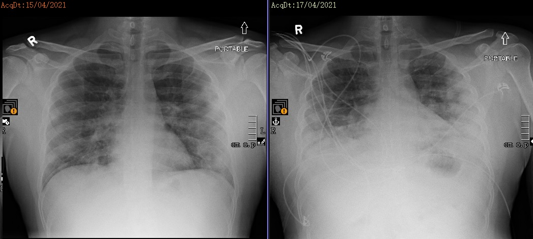 Finishing ICU night call - 6 new consults, all COVID.

The last one was in early 30s. Got COVID from parent who works at a warehouse. They got sick because two coworkers showed up to work with a fever and cough.

His x-ray, worsened over 48 hrs. Now in ICU. 30s.

PAID SICK LEAVE!