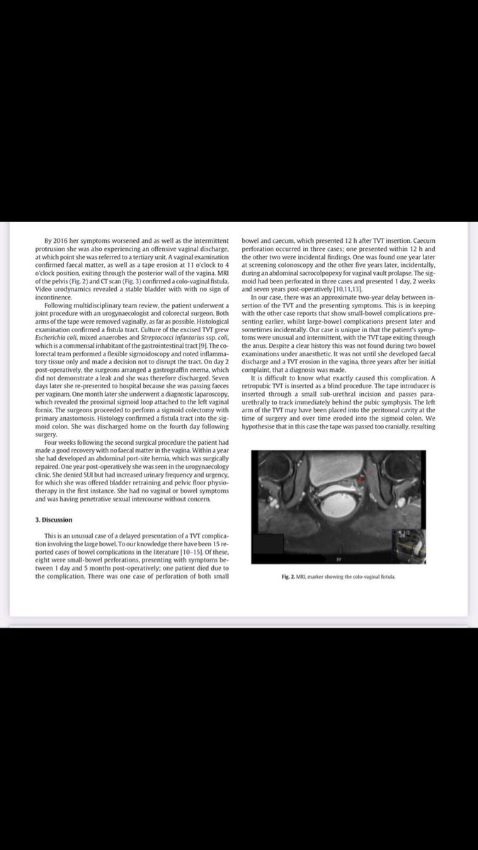Bluesparkled's tweet image. Case report of woman with #mesh cutting her bowel which claims its a rare complication &quot;in the literature&quot; but thats only as nobody has written about it. Doesnt mean it isnt happening. 1/3 of our group had mesh slice organs or thru vaginal walls #casualty