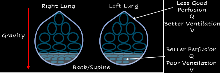 Would you like a little free lesson on ARDS and proning + a podcast. Go to my website criticalcarepractitioner.co.uk/ards-and-proni… ...and you can have my FREE PDF too! #FOAMed