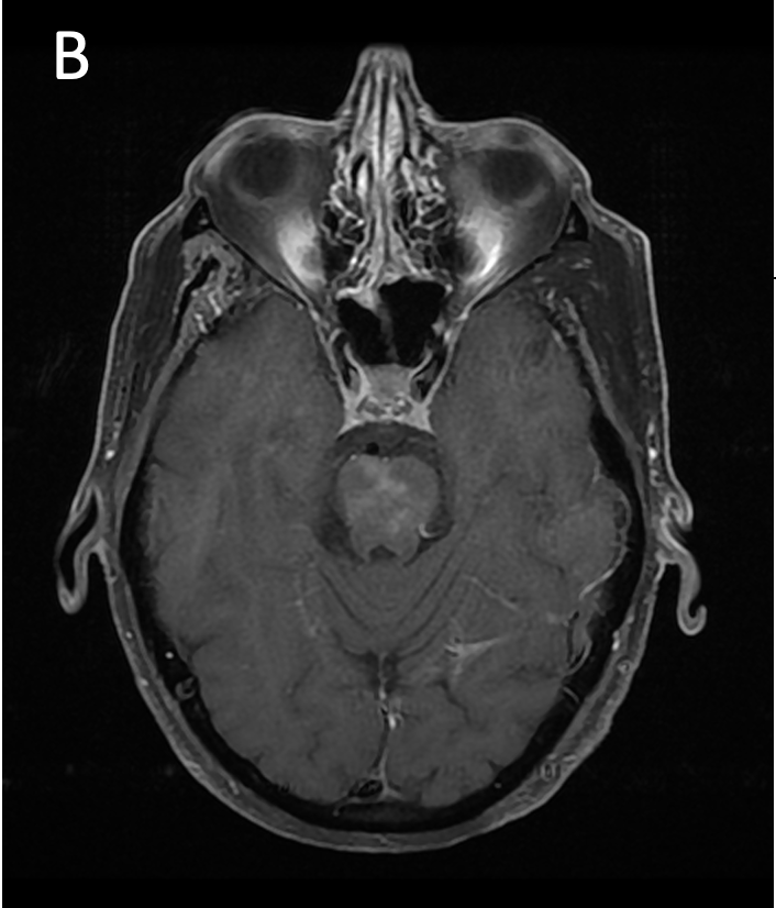 Applied_Rad's tweet photo. Contrast-enhanced MRI was integral to diagnosing and surveying IgG4-related sclerosing disease of the central nervous systems (CNS) with orbital involvement. Learn more in this #MRI case review. https://t.co/I41lzW8ytQ #MRI #NeuroImaging #Radiologist #CEMRI @GuerbetGroup https://t.co/Y3QEo5m84D