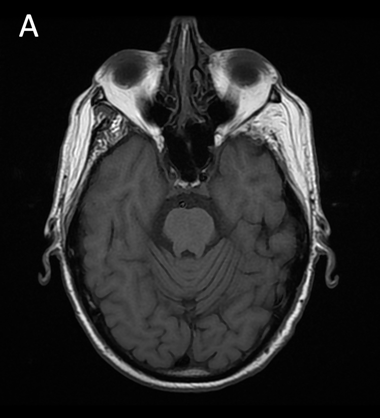 Applied_Rad's tweet photo. Contrast-enhanced MRI was integral to diagnosing and surveying IgG4-related sclerosing disease of the central nervous systems (CNS) with orbital involvement. Learn more in this #MRI case review. https://t.co/I41lzW8ytQ #MRI #NeuroImaging #Radiologist #CEMRI @GuerbetGroup https://t.co/Y3QEo5m84D