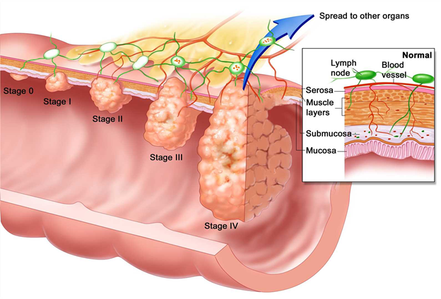 2/ What does Lucid Diagnostics address?Early detection in:- Adenocarcinoma of the esophagus ("EAC") i.e., esophagus cancer- Barrett's Esophagus ("BE")EAC primarily caused by chronic heartburn / acid reflux, or GERD. Stomach acid damages cells in esophagus.