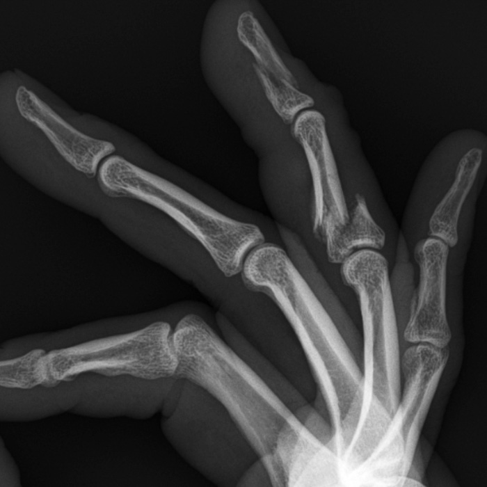 MDVancleave's tweet photo. On Monday night I was shot in the hand by a rubber bullet fired by police in Brooklyn Center while covering a protest. The impact broke my ring finger in two places requiring surgery. I won’t be able to pick up my camera again for at least six weeks. https://t.co/IcPfjbVug4