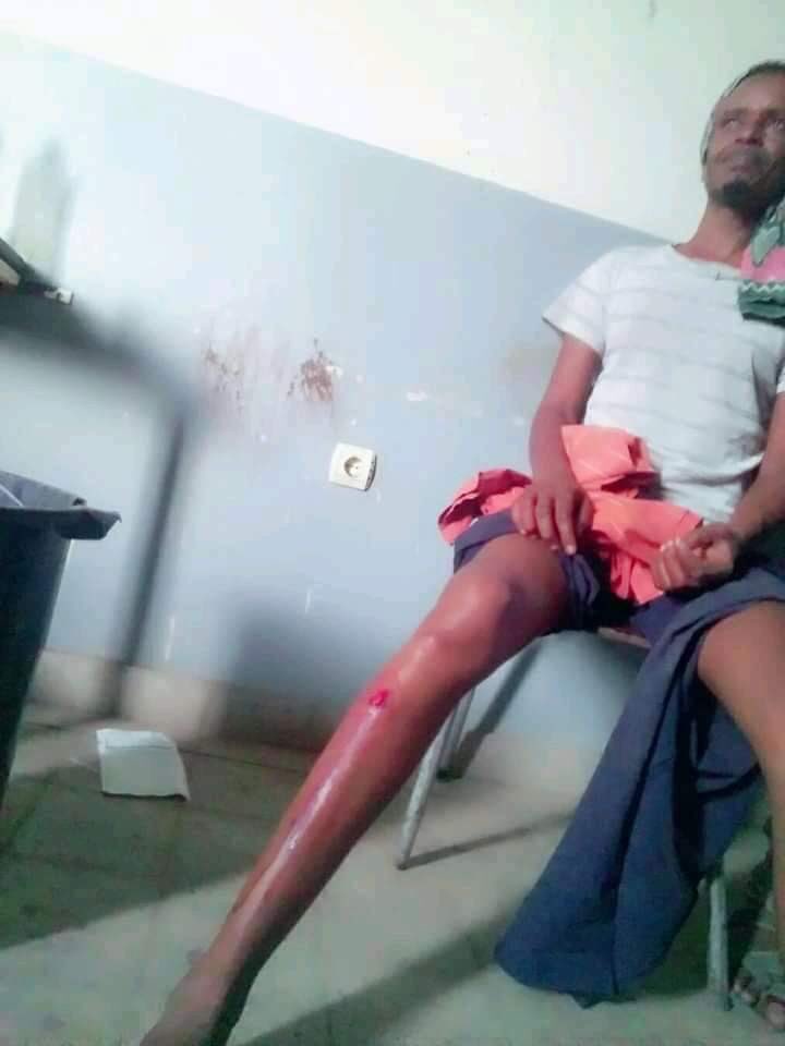 Hussein Tufa (@hassankadir1978) on Twitter photo His name is Osman a resident of West Hararge. He was assaulted by Militias in the surrounding b/c he refused to register to vote on the forthcoming election. The people are sending you a message EU! Quit
<a href="/JosepBorrellF/">Josep Borrell Fontelles</a>
#EUQuitLegitimizingShamElection
#FAC His name is Osman a resident of West Hararge. He was assaulted by Militias in the surrounding b/c he refused to register to vote on the forthcoming election. The people are sending you a message EU! Quit
<a href="/JosepBorrellF/">Josep Borrell Fontelles</a>
#EUQuitLegitimizingShamElection
#FAC