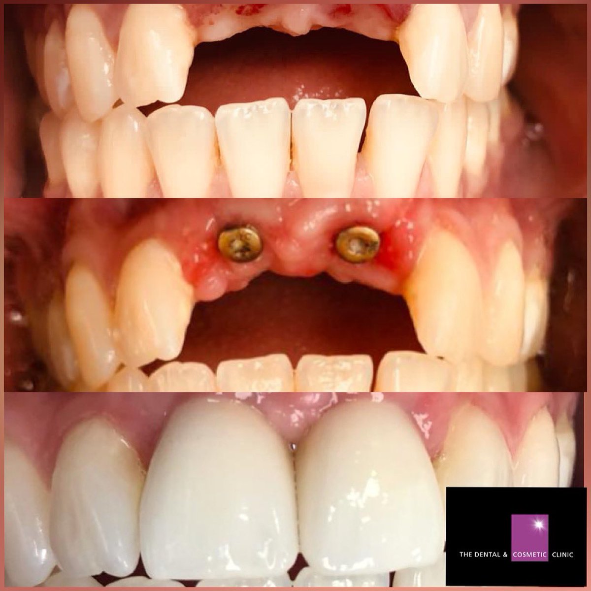 DentandCosmetic's tweet image. A good result for 2 front missing teeth was achieved here with @straumannuk implants where bone width was very limited. #straumann #straumannimplants #aestheticdentistry
