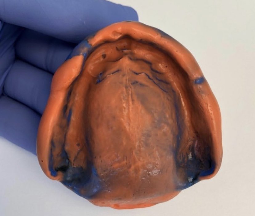 RyanMcCallDDS's tweet photo. Full upper denture impression 👌 https://t.co/2PbBIcZb7G