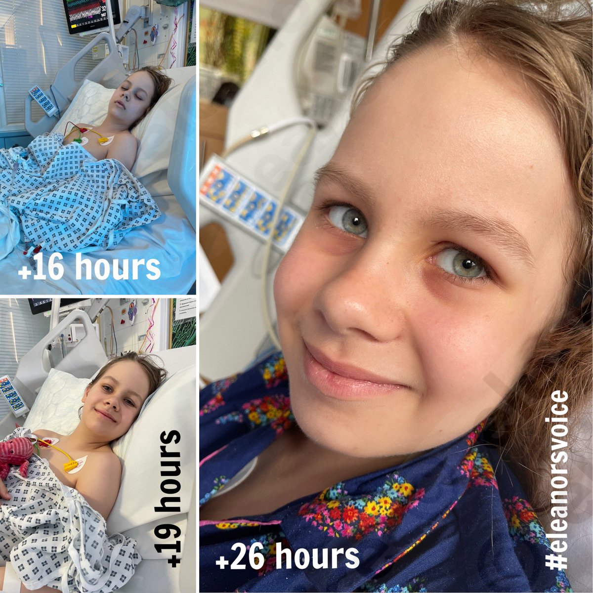 Eleanor is surpassing milestones! In just under 24 hours from major neurosurgery, she’s been transferred from HDU to general neuro recovery. It’s still very early days, despite how you may interpret pictures; but any progress is good progress! #keepsending 🤞🏼#eleanorsvoice 🤕💜✨