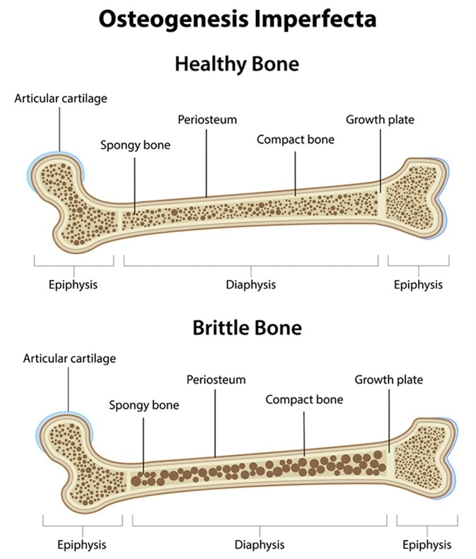 PracticalPOCUS's tweet photo. A while back, we asked for help on getting more content.  @DavidWright and @katerandolph answered that call and provided a podcast on osteogenesis imperfecta.  Hope you enjoy this unique podcast. Reach out if you want to contribute!
https://t.co/RTQVmoM3lh
#TotalEM #POCUS #MedED https://t.co/kmjWbLwm13