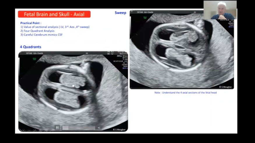 ISUOG's tweet photo. A fast paced and highly detailed scan demonstration from Simon Meagher on the first trimester is live now with lots of tips and tricks. Are you watching along and taking notes? #IS2021 #firstrimester #ultrasound https://t.co/6dXgAq0DLG
