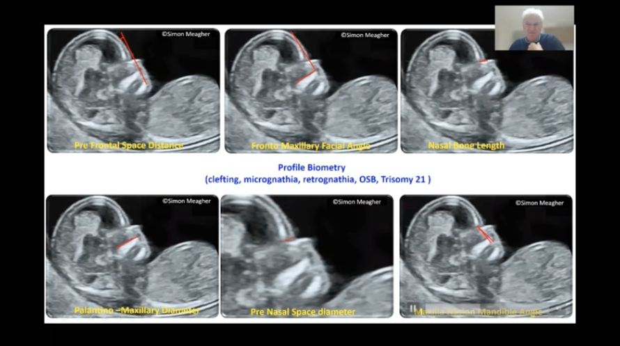 ISUOG's tweet photo. A fast paced and highly detailed scan demonstration from Simon Meagher on the first trimester is live now with lots of tips and tricks. Are you watching along and taking notes? #IS2021 #firstrimester #ultrasound https://t.co/6dXgAq0DLG