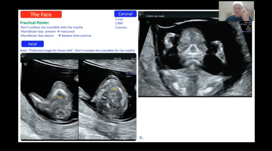 ISUOG's tweet photo. A fast paced and highly detailed scan demonstration from Simon Meagher on the first trimester is live now with lots of tips and tricks. Are you watching along and taking notes? #IS2021 #firstrimester #ultrasound https://t.co/6dXgAq0DLG