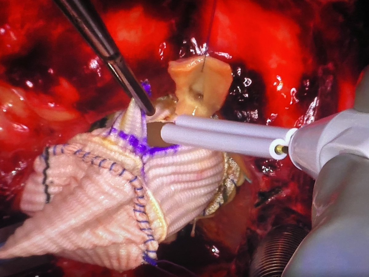 AortaSurg's tweet photo. Sewing on the right coronary button with autologous pericardial washer/“doughnut.” #aorticsurgery #aorta #aortaed https://t.co/JH9VtRzAox