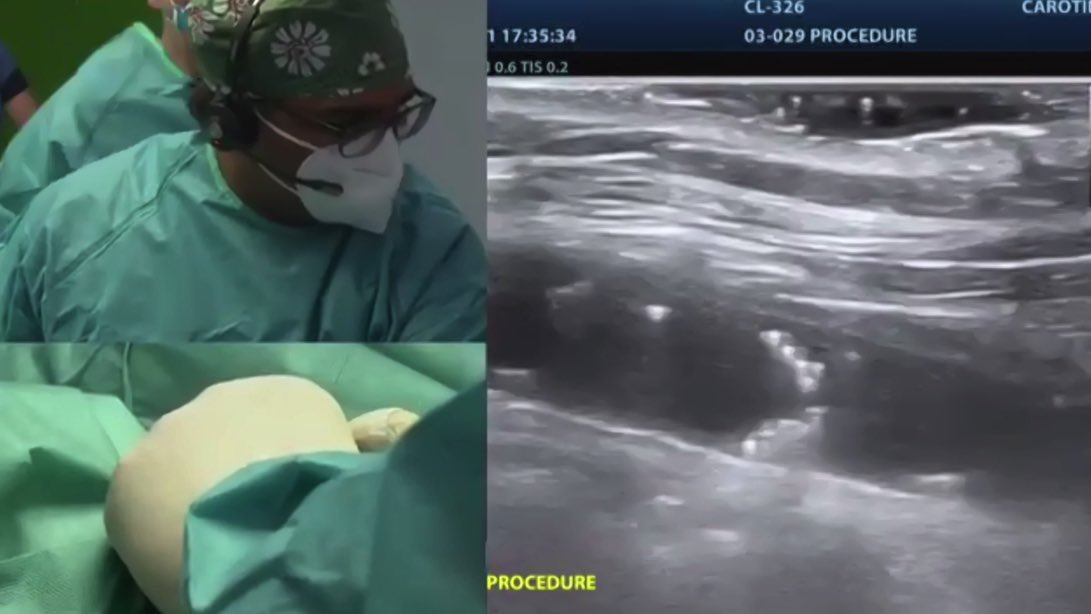 Dr. Devi G Nair (@drdevignair) on Twitter photo Permanent Carotid coil filter implants as live case from Prague by Dr. Vivek Reddy at #ISLAA2021 . Possible adjunct stroke prevention strategy in the future. <a href="/DJ_Lakkireddy/">DJ Lakkireddy</a> <a href="/deering_f/">ThomasFDeering</a> Permanent Carotid coil filter implants as live case from Prague by Dr. Vivek Reddy at #ISLAA2021 . Possible adjunct stroke prevention strategy in the future. <a href="/DJ_Lakkireddy/">DJ Lakkireddy</a> <a href="/deering_f/">ThomasFDeering</a>