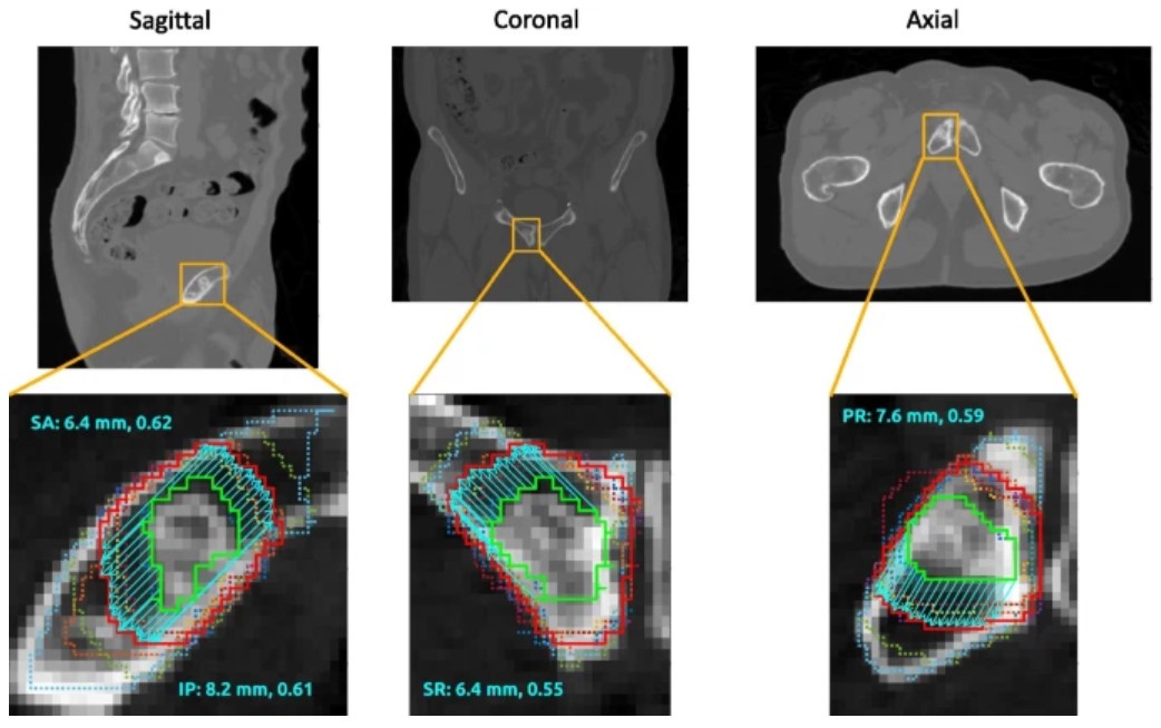 Matthias Guckenberger (@mat_guc) on Twitter photo Despite isotropic margins are widely used in #radonc , there are many situations where this approach is suboptimal
π Interesting methodology for computing direction-dependent margins for the development of consensus contouring guidelines
<a href="/SahgalArjun/">arjun sahgal</a>
rdcu.be/ciUqb Despite isotropic margins are widely used in #radonc , there are many situations where this approach is suboptimal
π Interesting methodology for computing direction-dependent margins for the development of consensus contouring guidelines
<a href="/SahgalArjun/">arjun sahgal</a>
rdcu.be/ciUqb