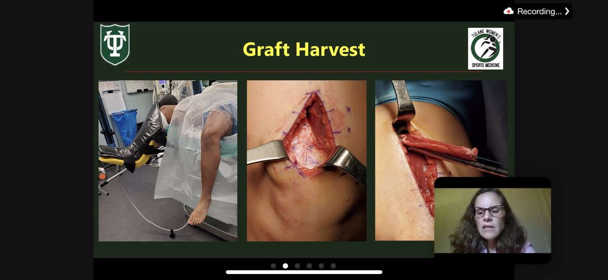 H2O_SportsMD's tweet photo. 🙏 to @TulaneOrtho’s finest &amp; our guest lecturer @marykmulcaheymd. Great to have generous friends &amp; colleagues “swing by” for a power hour of education on quad autograft #ACLR &amp; multidisciplinary considerations for return to sport. Just a placeholder til in person! #laudthequad https://t.co/QH9FiaSWKR