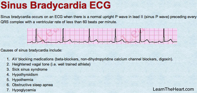 LearntheHeart's tweet photo. Sinus Bradycardia #ECG: Heart rate < 60 beats/minute. Name at least 7 causes. #USMLE #cardiology https://t.co/KdaxBNbV4g