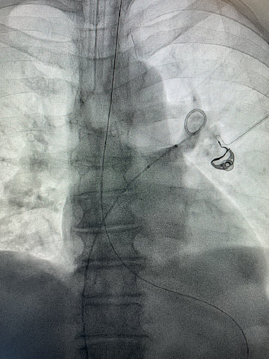 Joe Golowa (@joeygolow) on Twitter photo Crossing the Tricuspid valve with firmed pigtail for pulmonary artery #pe #thrombectomy. Where is that catheter going?? #PERT #irad <a href="/PERTConsortium/">The PERT Consortium®</a> <a href="/InariMedical/">Inari, now part of Stryker</a> Crossing the Tricuspid valve with firmed pigtail for pulmonary artery #pe #thrombectomy. Where is that catheter going?? #PERT #irad <a href="/PERTConsortium/">The PERT Consortium®</a> <a href="/InariMedical/">Inari, now part of Stryker</a>