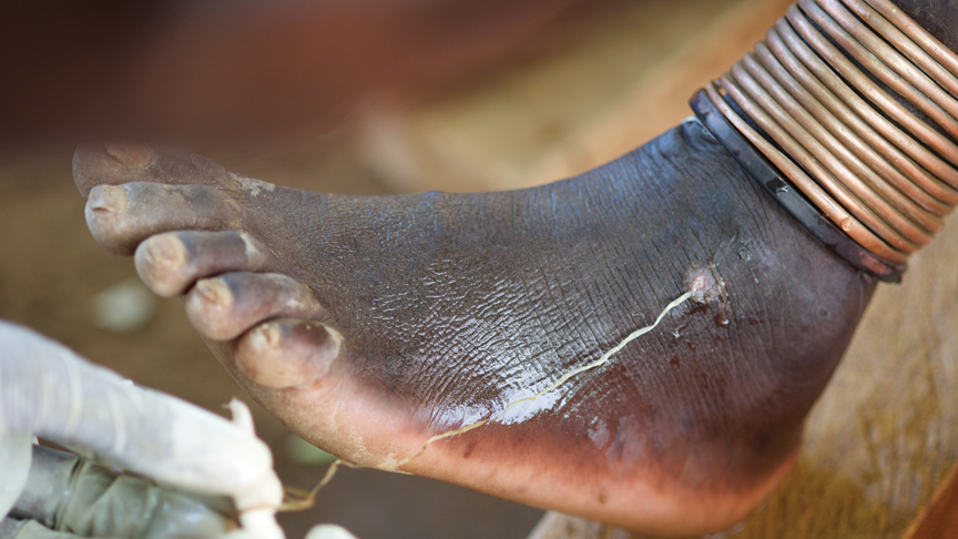 barnaby_flower's tweet photo. Guinea worm, caused by Dracunculus medinensis, was thought still endemic in only 5 African countries. 
But a new Dracunculus sp. not previously reported, has been described in a 23M in #Vietnam with no travel history.
Promed Post - ProMED-mail https://t.co/2EosVJajYu https://t.co/bVfmhbIygG