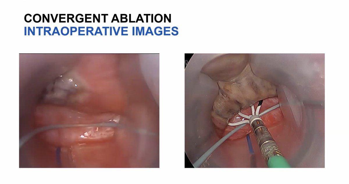 Now at Mayo Clinic CV grand rounds -- combined surgical/percutaneous collaborations to treat persistent atrial fibrillation - working together to advance patient care in remarkable ways @akillumd @Arghami @MayoClinicCV @SurajKapa @PanithayaC Soon at: cveducation.mayo.edu