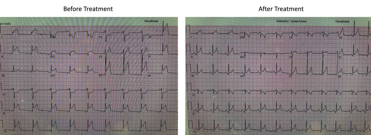 Eric Topol (@erictopol) on Twitter photo Very rare cases of pericarditis, myocarditis are being seen after mRNA vaccines. We've seen a few here in San Diego, too. It's time to get a handle on frequency and determine the mechanism.
See <a href="/AllaqabanSuhail/">Suhail Allaqaband</a> and <a href="/ihsan_rafie/">Dr Ihsan Rafie</a> posts, threads
ECGs via Dr. Allaqaband Very rare cases of pericarditis, myocarditis are being seen after mRNA vaccines. We've seen a few here in San Diego, too. It's time to get a handle on frequency and determine the mechanism.
See <a href="/AllaqabanSuhail/">Suhail Allaqaband</a> and <a href="/ihsan_rafie/">Dr Ihsan Rafie</a> posts, threads
ECGs via Dr. Allaqaband