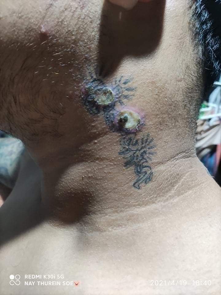 don_msi's tweet photo. A man was arrested during a strike in North Dagon on the 14th and was released today and then his tattoo was destroyed by the terrorist military groups with cigarette butts.
#Apr19Coup 
#WeSupportNUG 
#WhatsHappeningInMyanmar https://t.co/7yDpiIR3Ch