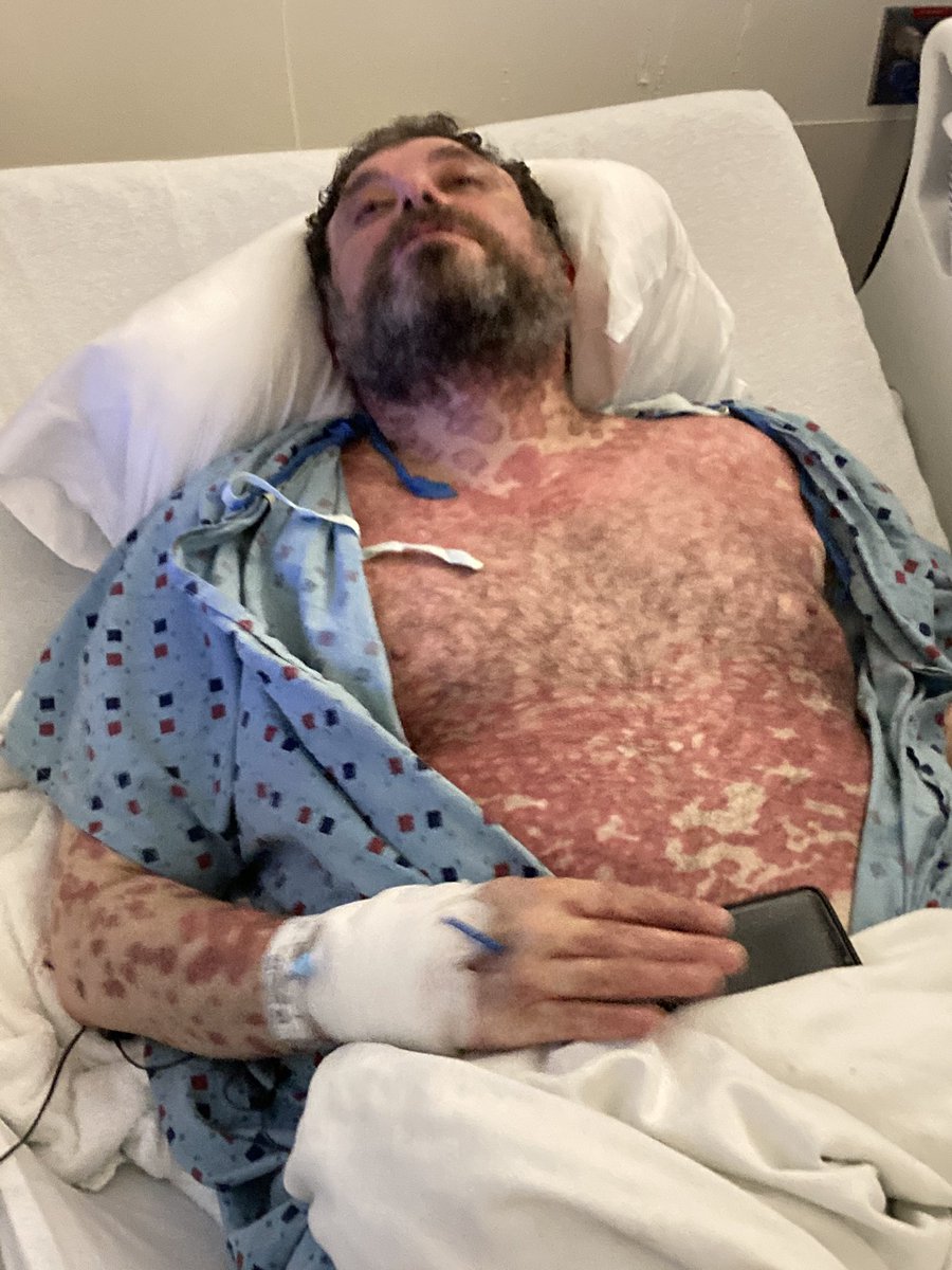 1/ For  #Covid vaccines, shingles and even more dangerous and painful skin rashes may be the new thrombocytopenia. (Photos of Allen Luxenberg, now hospitalized in New York for lesions he fears were caused by his Moderna vaccination.)