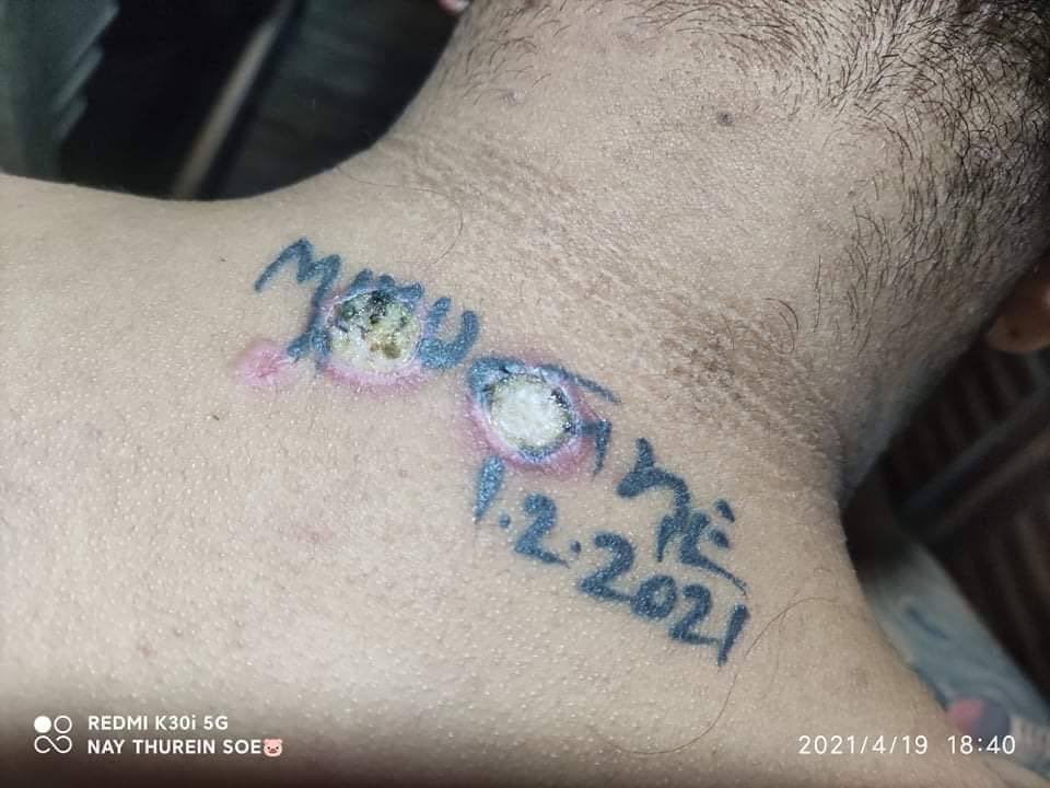 Tw // sensitive content 
An abductee was tortured with cigarette burns on his tattooed area just because the tattoo is about anti dictatorship.
#WhatsHappeningInMyanmar 
#Apr19Coup 
#CrimesAgainstHumanity