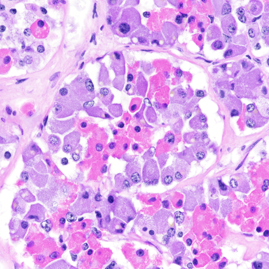 Nice look at a normal #pituitary gland. What do the pink cells produce, and what do the purple cells produce? #pathology #neuropath #PathTwitter #endocrinology