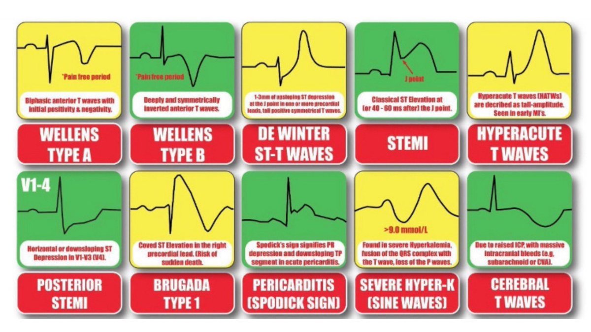 gonzaeperez's tweet image. #ECGfirst Great Picture 
🔘Acute coronary syndrome
🔘Brugada 
🔘Pericarditis 
🔘Hyper K
🔘Cerebral T waves
#FOAMed #Cardiotwitter