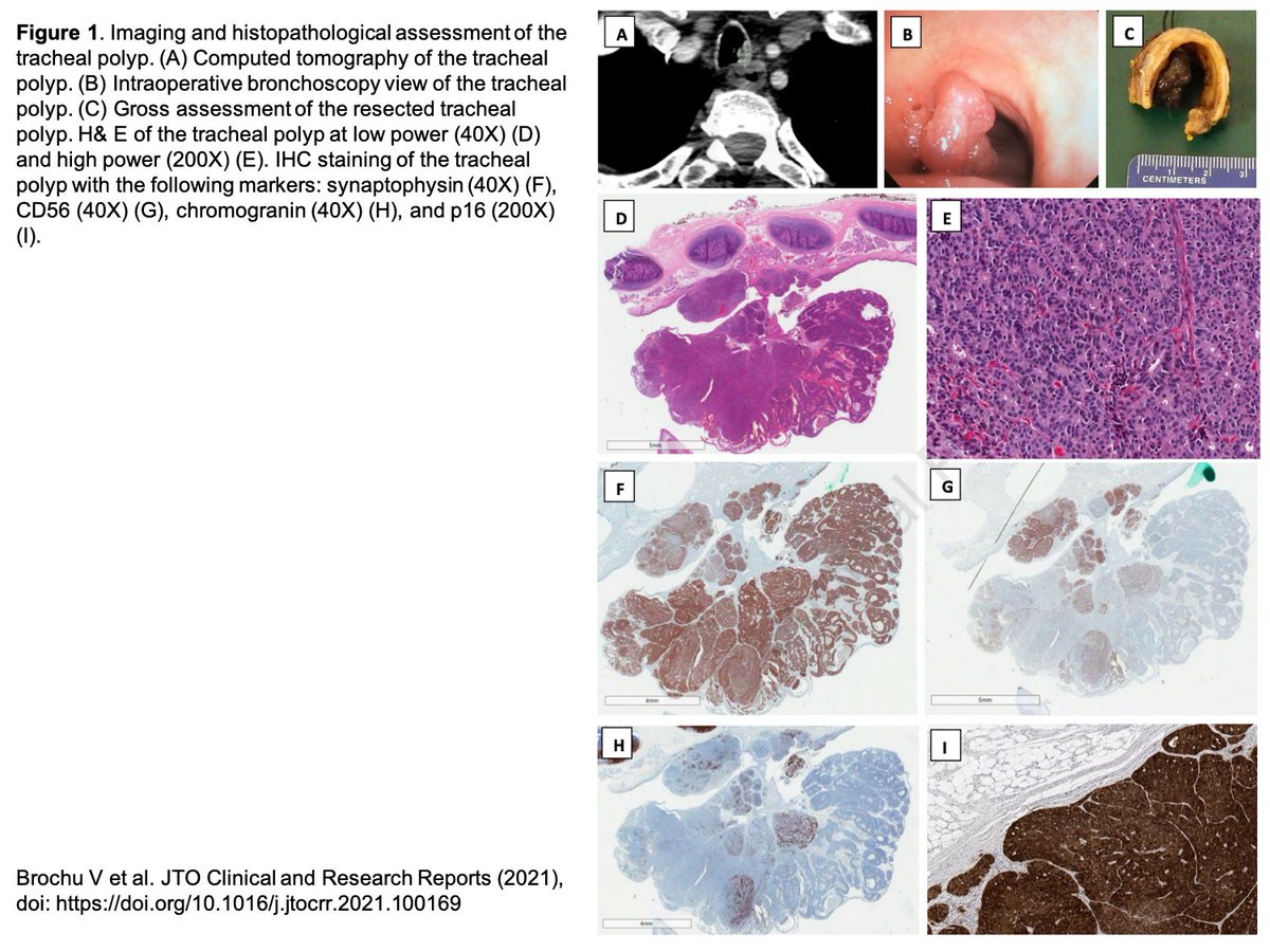 Iaslc The Report By Brochu Et Al Was The First To Describe The Characterization Of Genomic Profiles Pathogenesis And Natural History Of A Case Of Polypoid High Grade Neuroendocrine Carcinoma Of