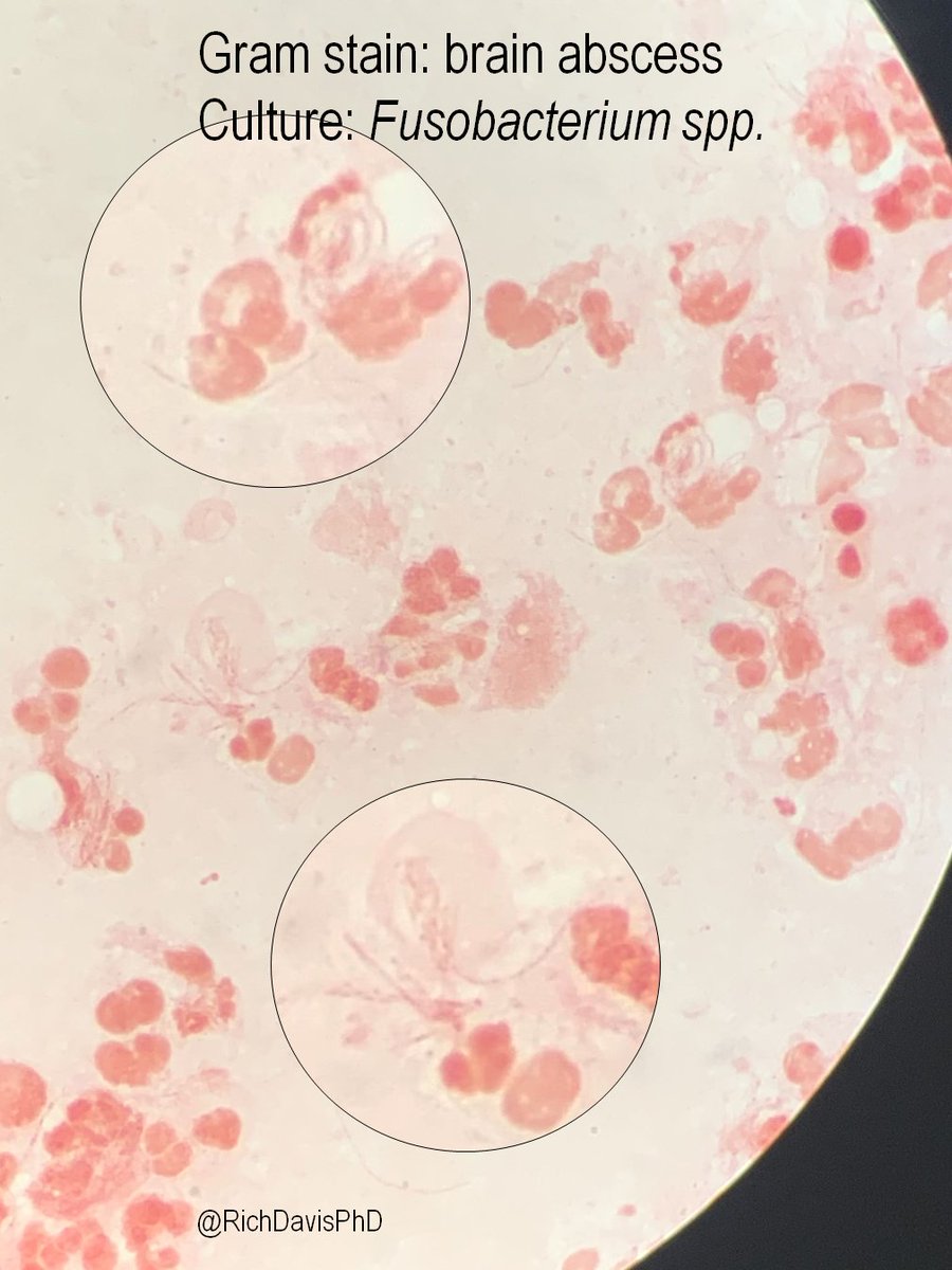 richdavisphd's tweet image. #MicroRounds (Day 843): For #LabWeek2021, a Gram stain from a brain abscess, pt w/ hx of dental work. Do you see anything? 

An example of #WhyClinMicroMatters: tech with great eyes called fusiform Gram neg rods. Grew Fusobacterium spp. #ASMClinMicro #IDTwitter #IAmClinMicro