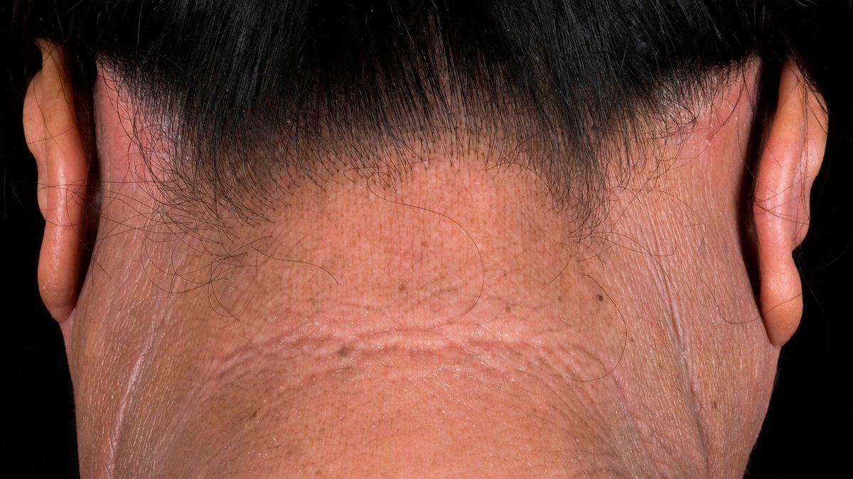 時事メディカル １５ ６９歳の男女１２００人を対象にしたインターネット調査によると 頭皮 のトラブルを抱える人は２０ ７ で ５人に１人に上った 具体的には かゆみ は７２ ７ フケ ４５ ５ ぶつぶつ 炎症 赤み が４２ ８ となって