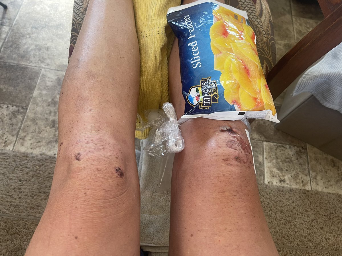 olybug's tweet photo. I know in hindsight, it’s not a biggie. But when you live life on the road and you have lot of grandeur plans, an injury like this stops your life for 6 months and a LOT OF $$$...

#injury #thecamphostlife #depressed #fulltimerv #adventureattorney #lawyer #saga #feelingblue #sad https://t.co/7NUVe6xgOy