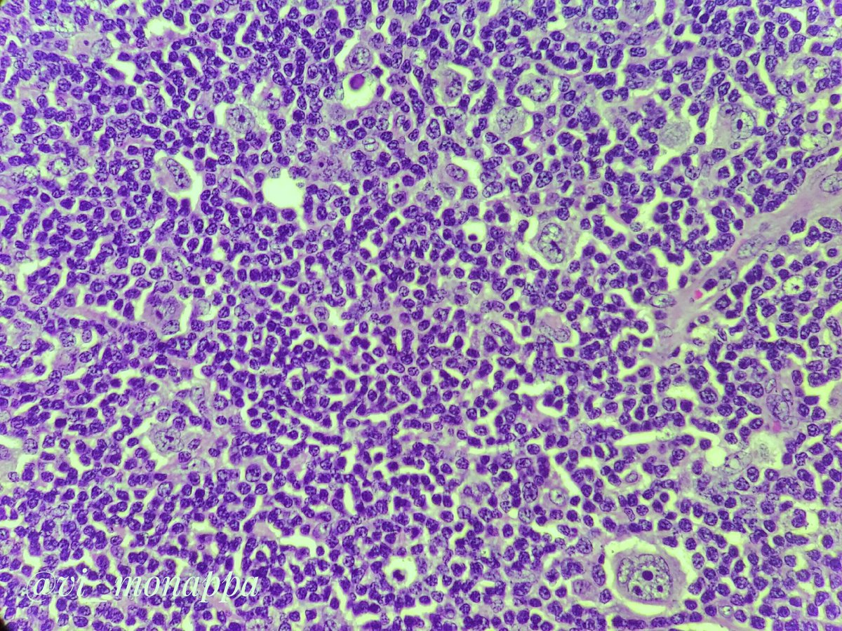 Vidya Monappa (@vi_monappa) on Twitter photo 1. Young female LN. #pathology #pathtwitter #LNPath #hemepath
#pathboards
Based on the images what is ur probable diagnosis? See poll 👇
<a href="/kriyer68/">Kalyani Bambal</a> <a href="/ariella8/">Celina Stayerman MD</a> <a href="/VijayPatho/">Vijay Shankar S</a> <a href="/KMirza/">Kamran Mirza MD PhD - کامران مرزا</a> <a href="/ShirazFidai/">Shiraz Fidai</a> <a href="/nucleololailo/">Carlos Miguel Ruiz</a> <a href="/HENRYY_MD/">Henry YANG</a> <a href="/TristanRutland7/">Tristan Rutland MBBS FRCPA IFCAP</a> <a href="/pepeheffernan/">Pepe Jiménez Heffernan</a> <a href="/DrGeeONE/">Olaleke Folaranmi</a> <a href="/SumantaDas_7/">Sumanta Das</a> 1. Young female LN. #pathology #pathtwitter #LNPath #hemepath
#pathboards
Based on the images what is ur probable diagnosis? See poll 👇
<a href="/kriyer68/">Kalyani Bambal</a> <a href="/ariella8/">Celina Stayerman MD</a> <a href="/VijayPatho/">Vijay Shankar S</a> <a href="/KMirza/">Kamran Mirza MD PhD - کامران مرزا</a> <a href="/ShirazFidai/">Shiraz Fidai</a> <a href="/nucleololailo/">Carlos Miguel Ruiz</a> <a href="/HENRYY_MD/">Henry YANG</a> <a href="/TristanRutland7/">Tristan Rutland MBBS FRCPA IFCAP</a> <a href="/pepeheffernan/">Pepe Jiménez Heffernan</a> <a href="/DrGeeONE/">Olaleke Folaranmi</a> <a href="/SumantaDas_7/">Sumanta Das</a>