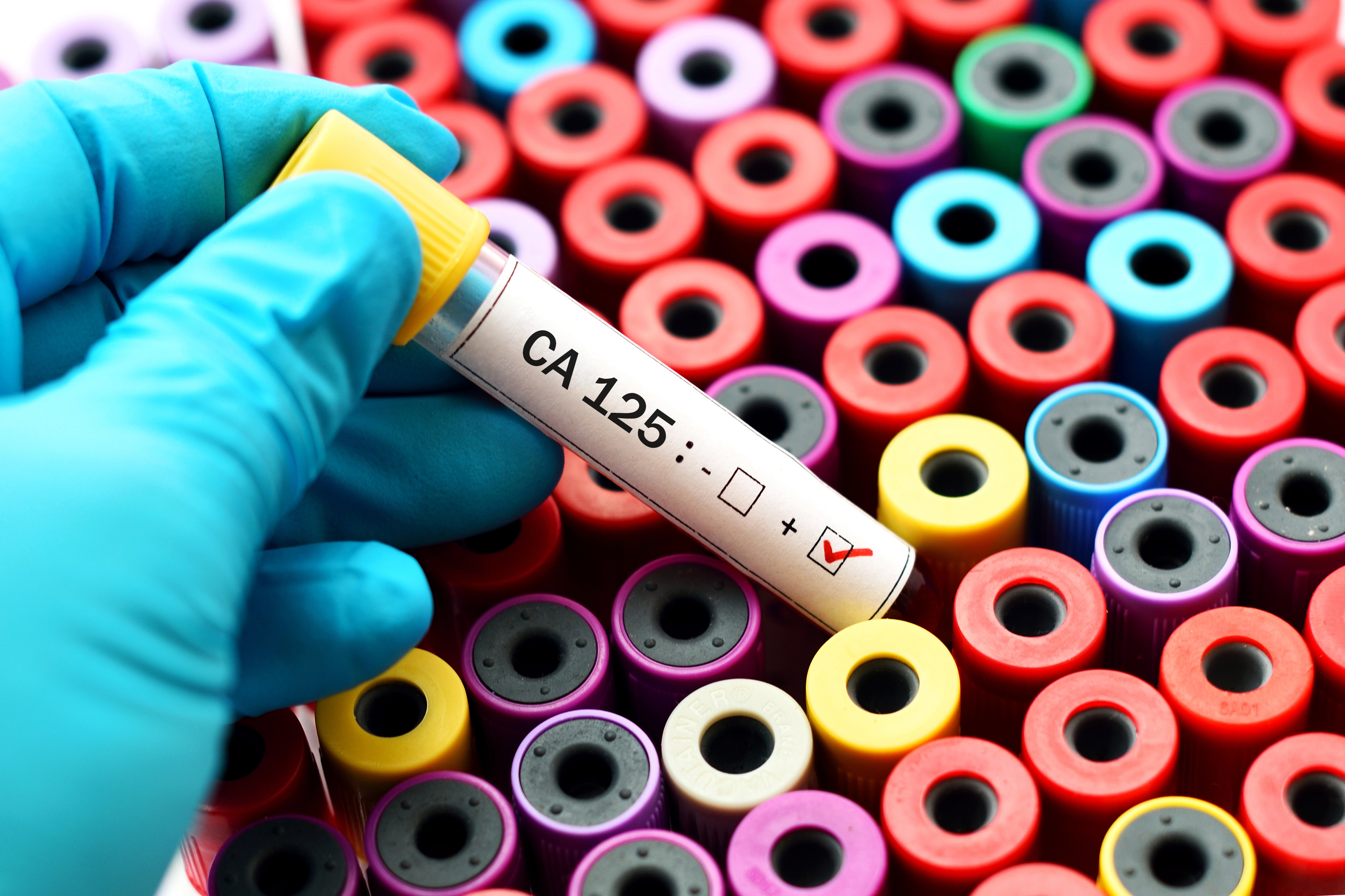 Can the CA-125 test detect other cancers?