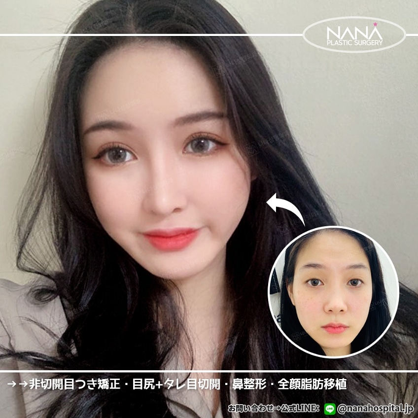 韓国nana美容整形外科 ビフォーアフター 手術内容 全顔脂肪移植 非切開目付き矯正 目尻切開 タレ目形成 鼻整形 お問い合わせ下さい 公式line 韓国整 By 韓国整形nana美容外科 Edayfm 韓国nana美容整形外科 ビフォーアフター 手術内容 全顔脂肪移植 非切開目付き矯正 目尻切開 タレ目形成 鼻整形 お問い合わせ下さい 公式line 韓国整 By 韓国整形nana美容外科 Edayfm