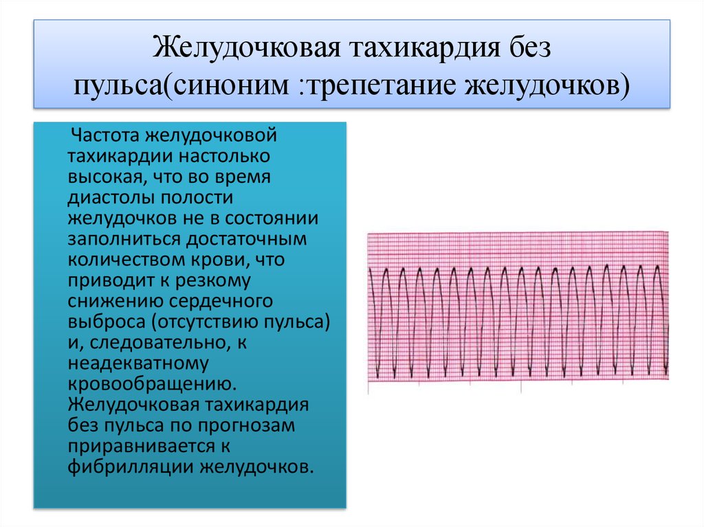 Клинические проявления пароксизма желудочковой тахикардии. Тахикардия у беременных 2 триместр. Синусовая тахикардия при беременности 3 триместр. Многофокусная предсердная тахикардия на экг. Нерегулярная предсердная тахикардия.