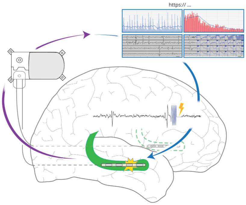 “Closed-loop” metaphor refers to device’s ability to sense (purple →) brain activity & deliver targeted stimulation (blue →) in response, unlike prevailing DBS that is preprogrammed without a neural control signal. A major research focus of   #BRAINInitiative  @NIH & globally.