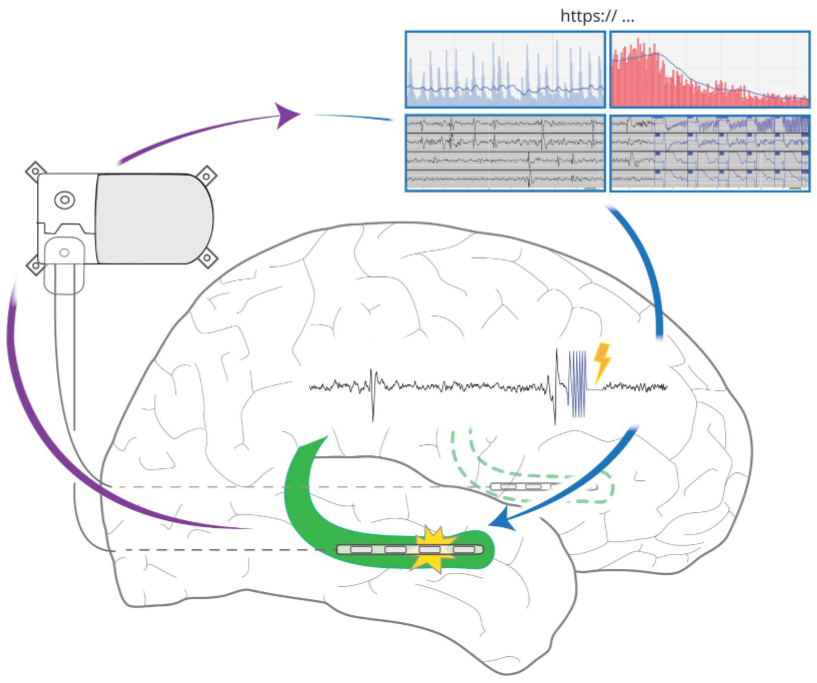 “Closed-loop” metaphor refers to device’s ability to sense (purple →) brain activity & deliver targeted stimulation (blue →) in response, unlike prevailing DBS that is preprogrammed without a neural control signal. A major research focus of  #BRAINInitiative  @NIH & globally.