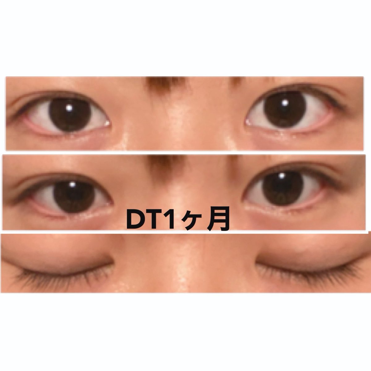 m44065460's tweet photo. 水の森 埋没 DT１ヶ月

撮り方思い出したからもう1回載せます笑

#二重埋没 #埋没 #埋没経過 #埋没記録 https://t.co/wjWXYecQF8