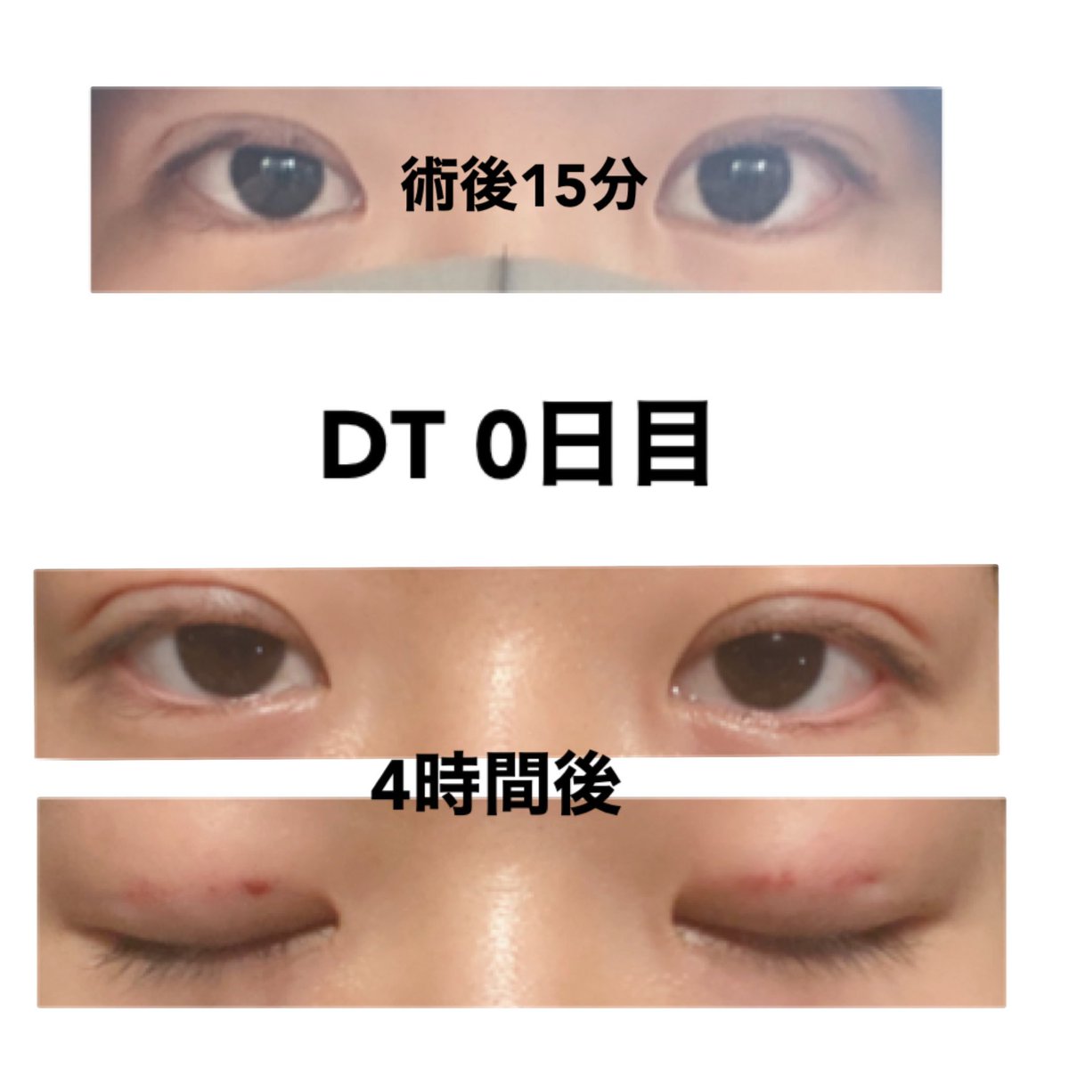 m44065460's tweet photo. 水の森 埋没 DT１ヶ月

撮り方思い出したからもう1回載せます笑

#二重埋没 #埋没 #埋没経過 #埋没記録 https://t.co/wjWXYecQF8