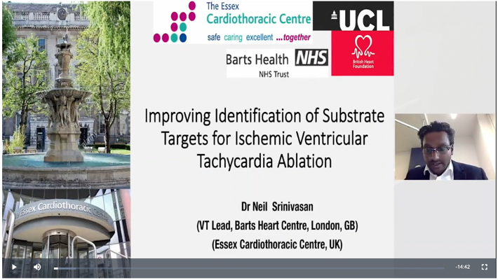 “By doing the sense protocol, we improved the sensitivity...and the specificity compared to sinus rhythm mapping to critical regions of the VT Circuit,” said @CallMe_DrNeil on his experience using #HDGrid Mapping Catheter.

Watch now and view safety info: bit.ly/3dS63Uy