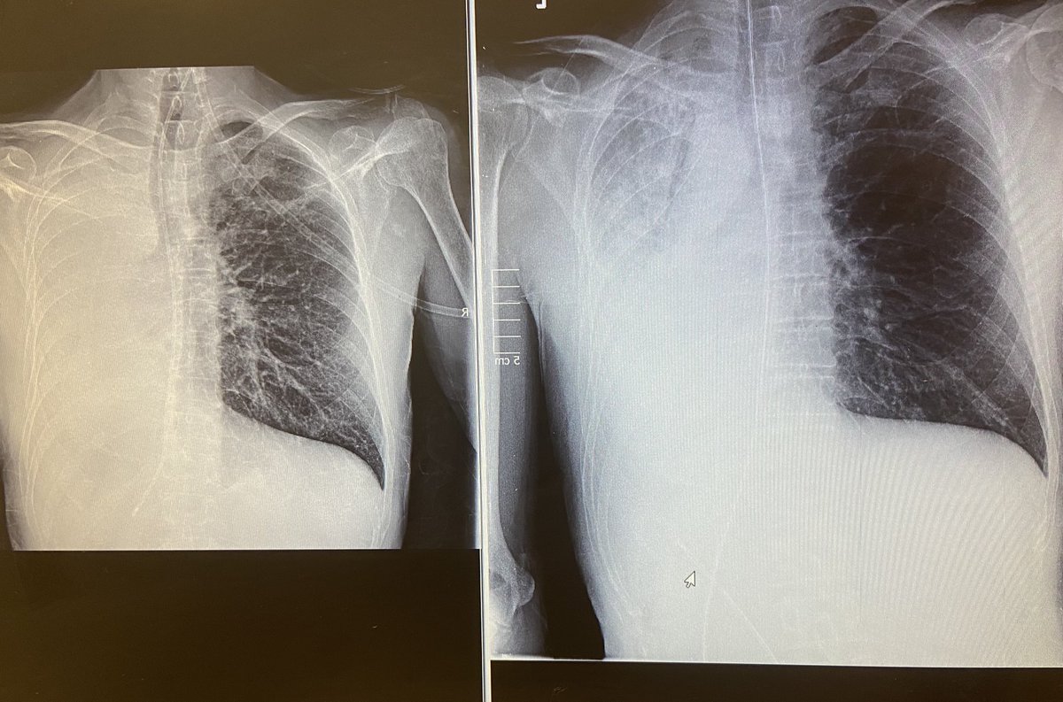Kate 💙 (@ptkate20) on Twitter photo New appreciation for the cough assist today 😍 left X-ray is pre treatment with a complete white out, the right x-ray shows post treatment 😍 improved patient comfort, reduced o2 requirement and +++secretions cleared! #respisbest <a href="/GWH_NHS/">Great Western Hospitals NHS Foundation Trust</a> <a href="/cafowen_/">Ceri Owen</a> <a href="/AndyHurden/">Andrew Hurden</a> 🫁🩺💪🏻 New appreciation for the cough assist today 😍 left X-ray is pre treatment with a complete white out, the right x-ray shows post treatment 😍 improved patient comfort, reduced o2 requirement and +++secretions cleared! #respisbest <a href="/GWH_NHS/">Great Western Hospitals NHS Foundation Trust</a> <a href="/cafowen_/">Ceri Owen</a> <a href="/AndyHurden/">Andrew Hurden</a> 🫁🩺💪🏻