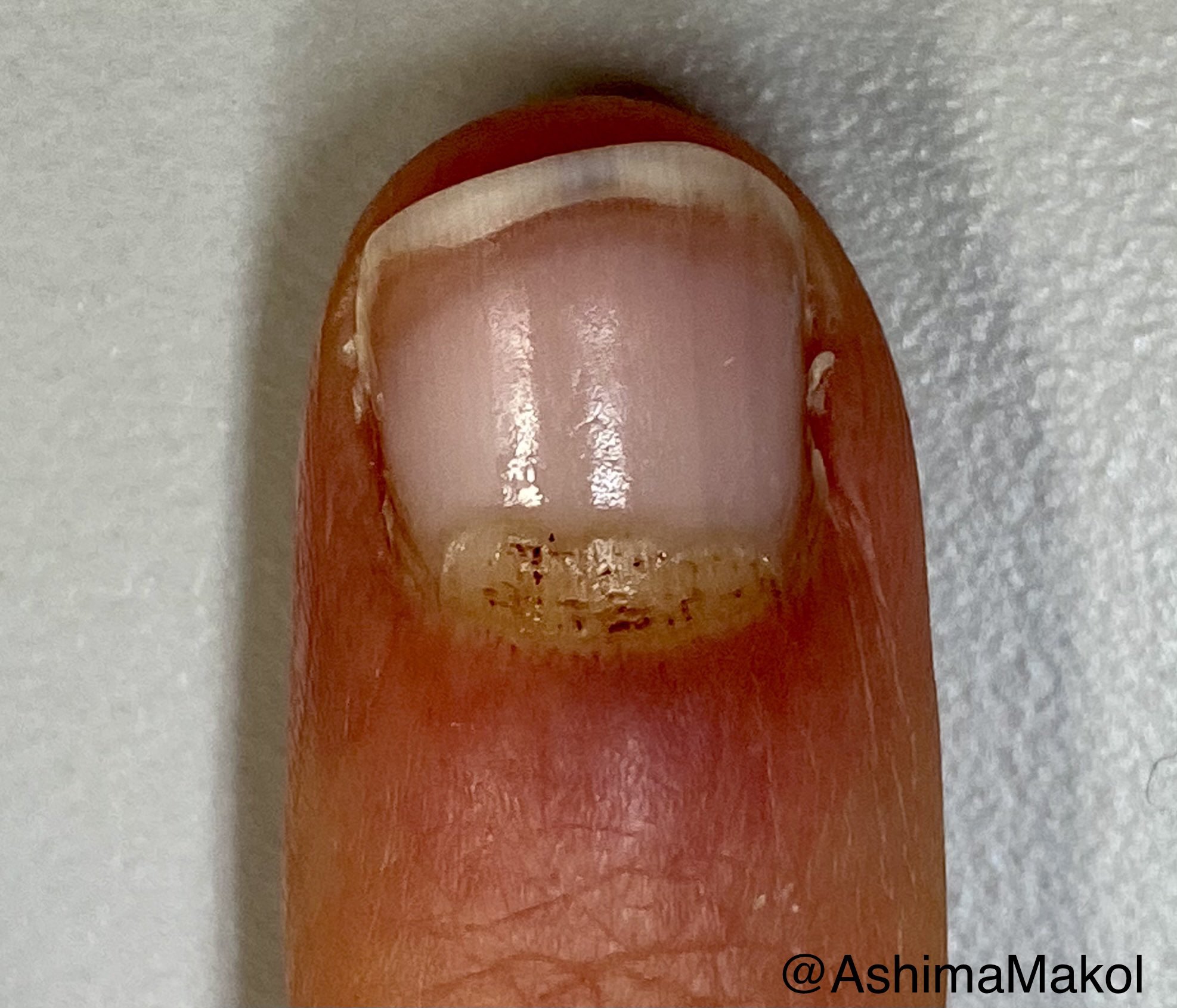 Nail toxicities due to targeted biologic drugs. A. Paronychia due to... |  Download Scientific Diagram