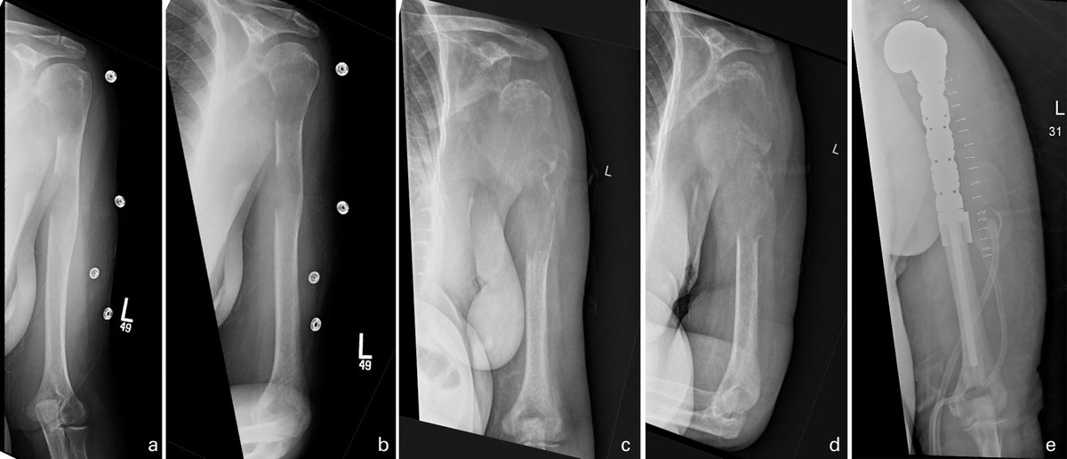 JUST PUBLISHED!: Did COVID-19 related delays in surgical management lead to patient morbidity in the orthopaedic oncological population? ow.ly/VUYY50EsTwk @howserj @NorthwellHealth #OrthoTwitter #Oncology