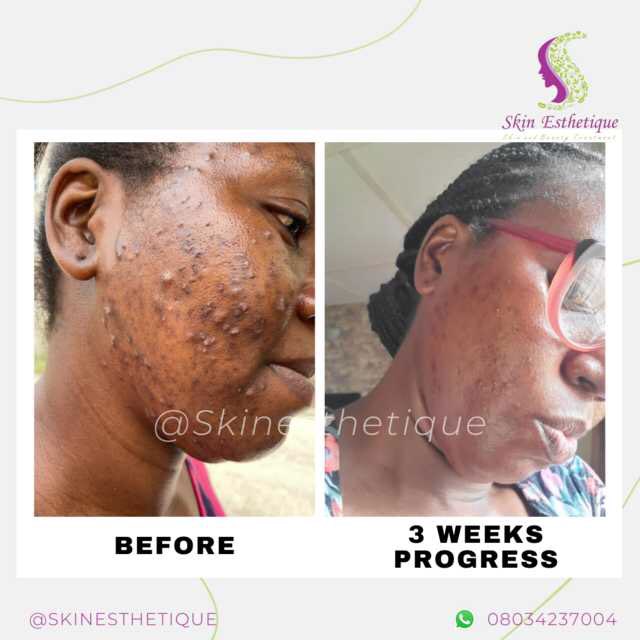 skin_esthetique's tweet photo. The #transformation you are seeing here is just 3 weeks after she began her treatment with us and the results are already beginning to be evident.
See picture of the product used in next slide. 
Send us a Dm or click on the link in bio to book an appointment with our #esthetician https://t.co/xoRNjCcpVc