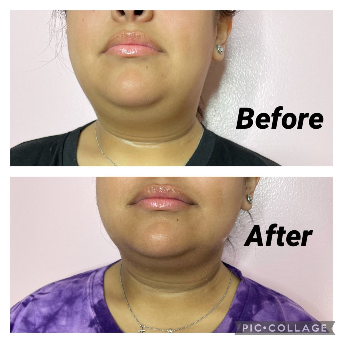 BarbieEsthetics's tweet photo. Double chin who??? 🪄
3/3 Sessions ✔️
Are you summer time ready? Book now link in bio! 🤍
#barbiedreamesthetics #doublechinreduction #skintightening #booknow https://t.co/KaxgoyBZxW