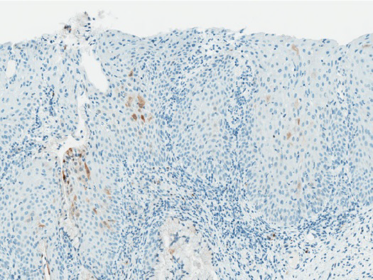RocheDiaUSA's tweet photo. You are looking at a cervical punch biopsy specimen stained with CINtec Histology. The p16 staining pattern is characterized as …?
1. Diffuse staining
2. Focal staining
3. Background staining
4. I don’t know
#tweetorialtuesday #IHCPath #cervicalcancer #RocheMSA https://t.co/n5G06Oc7Wq